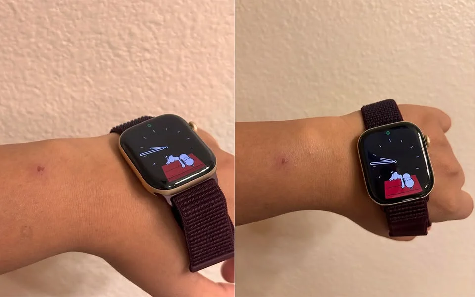 Một số người dùng Apple Watch Series 12 và Ultra 4 phản ánh tình trạng kích ứng da khi đeo các...